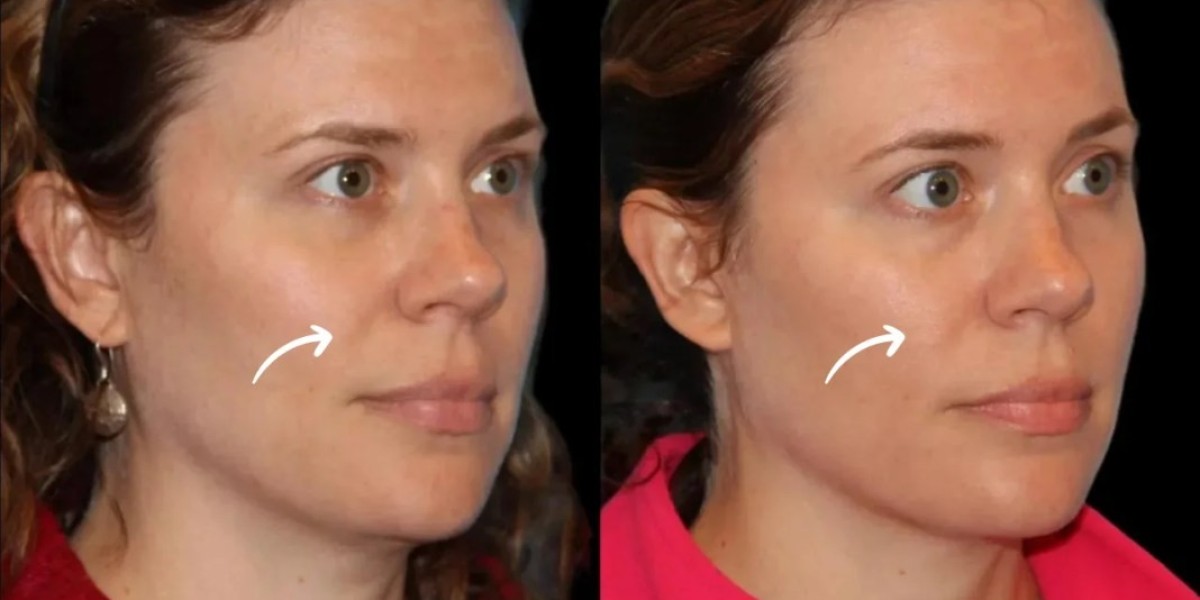 Best Aesthetic Clinic in Dubai for Sculptra Fillers Postpartum Abdomen