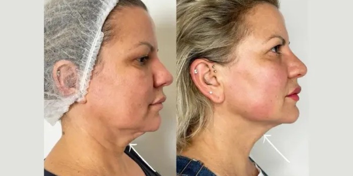 Best Aesthetic Clinic in dubai Using Endolift For Collagen Stimulation