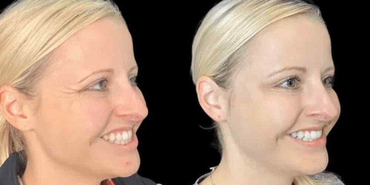 Botox Treatment in Dubai for Modern Anti-Aging Solutions
