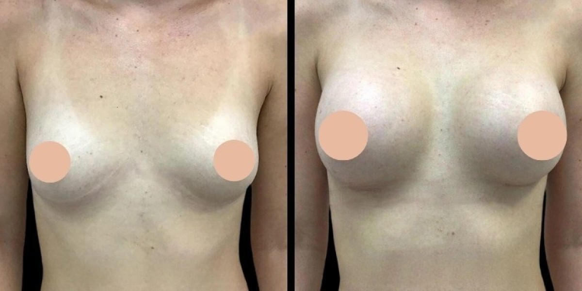 Breast augmentation in Dubai: How to Maintain Beautiful Results for Years