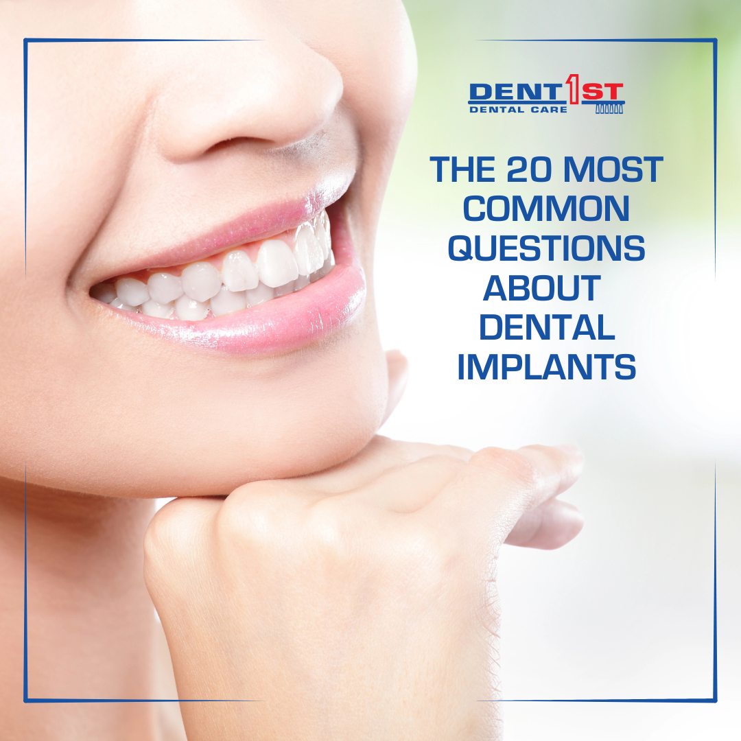 Top 20 Most Common Questions About Dental Implants