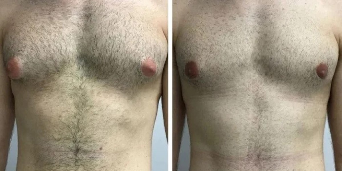 When Should Men Consider Surgery for Gynecomastia in Dubai